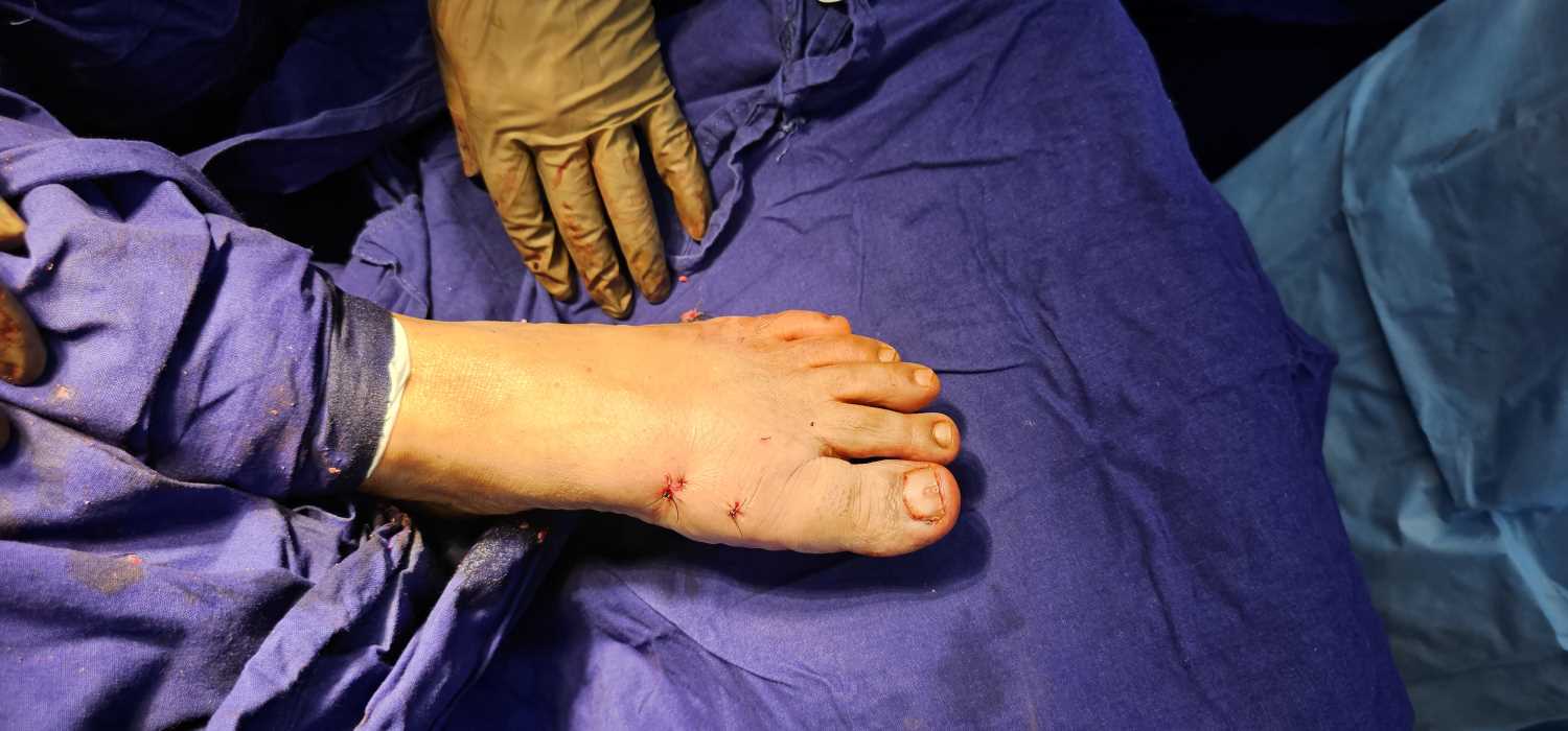 Minimally Invasive Surgery for foot