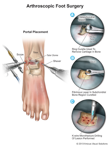 Best Foot And Ankle Surgeon In Mumbai Dr Pradeep Moonot Mkfac