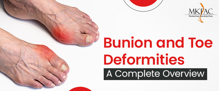 Bunion and Toe Deformities Treatments in Mumbai