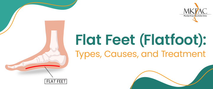 Flat Feet Specialists in Mumbai | MKFAC