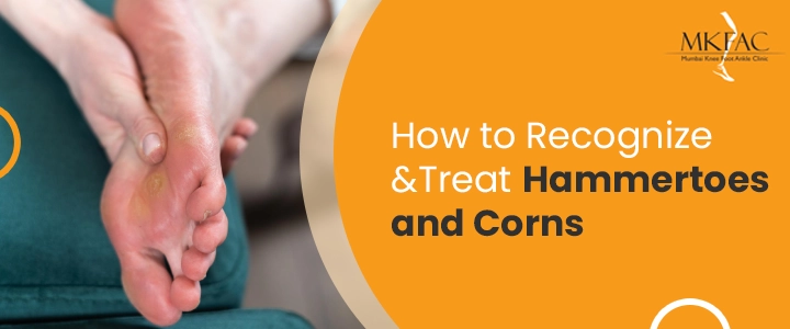 How to Recognize and Treat Hammertoes and Corns | MKFAC