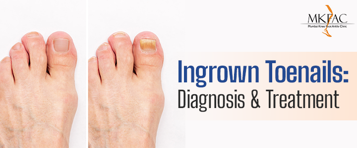 Ingrown Toenails-Diagnosis and Treatment | MKFAC