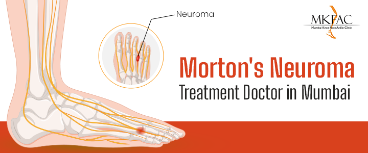 Morton's Neuroma Treatment Doctor in Mumbai | MKFAC