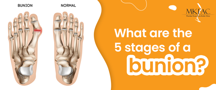 What are the 5 stages of a bunion | MKFAC